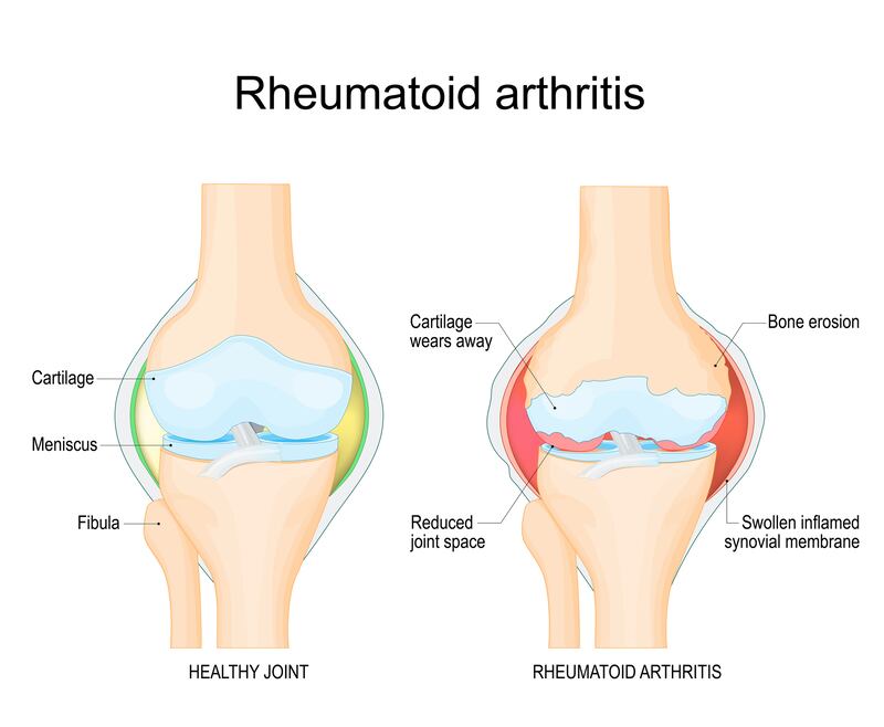 Rheumatoid arthritis of the knee joint. Illustration: Getty