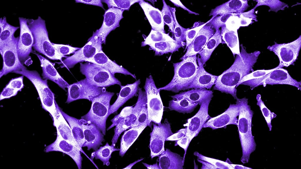 Researchers in Cork have been using bursts of electricity to treat primarily skin-based tumours, such as malignant melanoma. Photograph: Getty