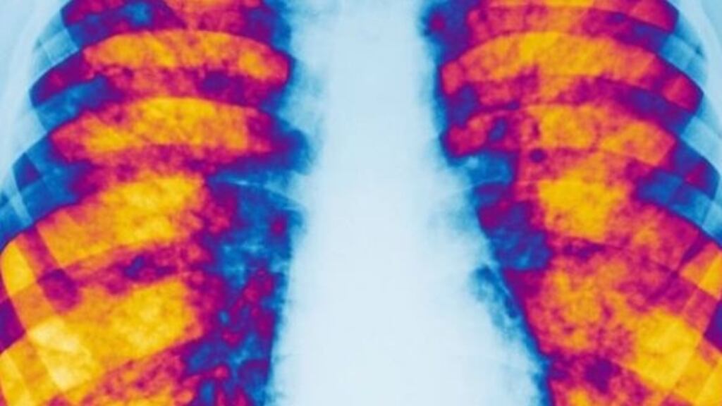 The HSE has indicted it is willing to pay €75m annually, but not the existing €400m bill across five years. Photograph: Getty Images