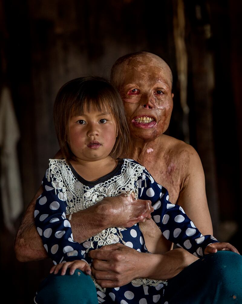 Yeyang Yang (31) with his daughter Syya (6) at their home in Banxang village, Phonsavan, Laos, in April 2017. He was burning rubbish when the heat of the fire ignited an unexploded ordnance in the ground. Yeyang spent eight months in hospital and still had to undergo further surgery. Photograph: Brenda Fitzsimons