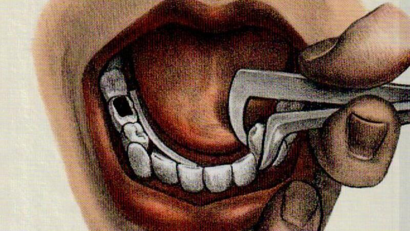 Open wide: how to pull out a tooth.