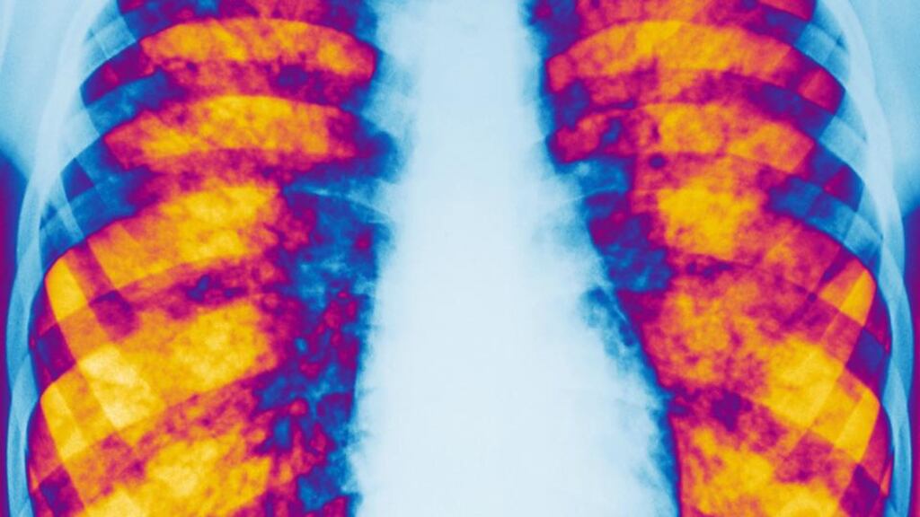 Cystic fibrosis affects more than 70,000 people worldwide.