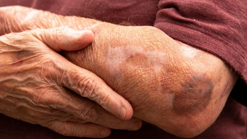 Mr Mulcahy’s  emphysema medication  has made his skin  as ‘thin as parchment’. He said his shower was too narrow, resulting in regular cuts and tears to his skin. Photograph: Mary Browne