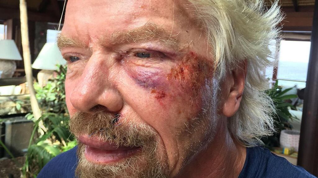 The Virgin founder badly damaged his cheek and suffered severe cuts to his knee, chin, shoulder and body. Photograph: Virgin.Com/PA Wire