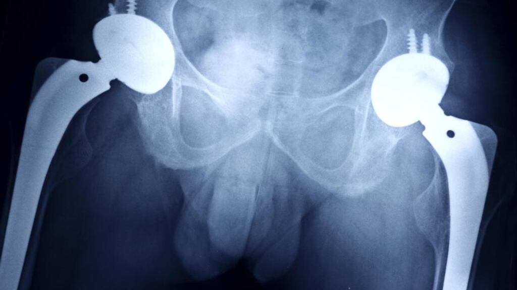 Orthopaedic implants and surgical equipment account for a large proportion of the vigilance reports received by the Irish Medicines Board.