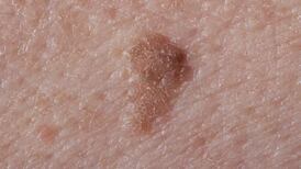 On Beauty: Deal with your liver spots without resorting to laser treatment