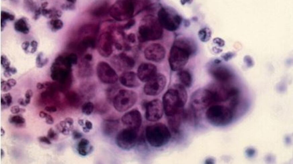 Adenocarcinoma cancer cells under a microscope. Some cervical cancers are of this type. File photograph: Getty Images