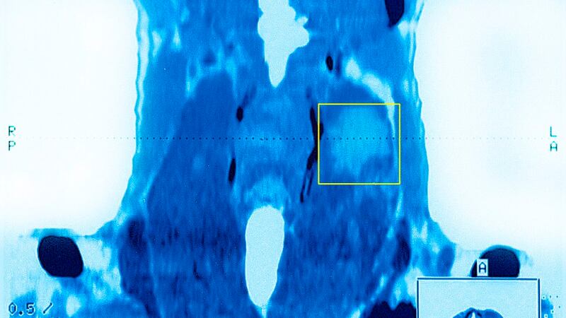 When thyroid hormone levels are low it can cause weight gain, tiredness and sensitivity to the cold. It can also cause sluggishness, dry skin, thinning hair, and long, heavy menstrual periods.