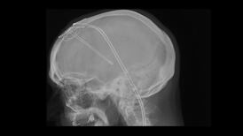 ‘Smart’ brain stimulation a sea change in management of Parkinson’s