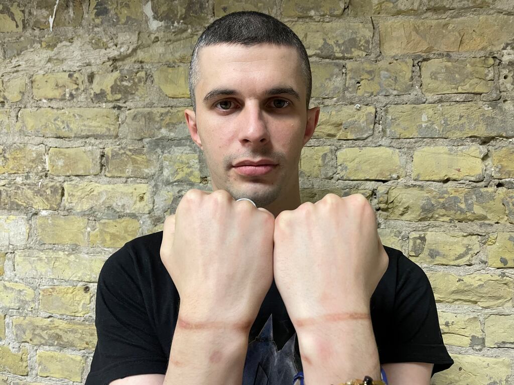 Oleh Anisimov, who was tortured during four months in Russian captivity, shows scars caused by being hung from handcuffs around his wrists. Photograph: Daniel McLaughlin
