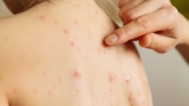 Chickenpox vaccine to be offered to babies at 12 months