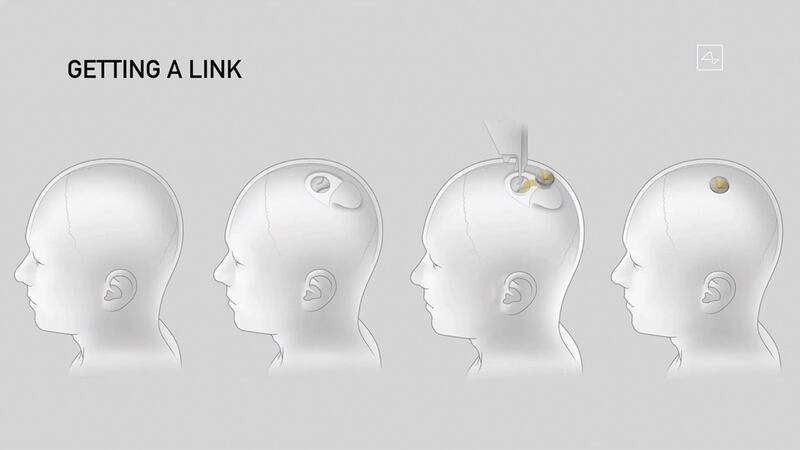 A drawing of the different steps of the implantation of a Neuralink device seen during the presentation Friday. Photograph: Neuralink/AFP via Getty Images
