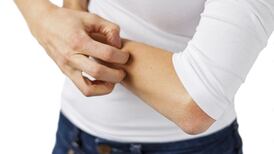 Malin-backed eczema drug company signals IPO