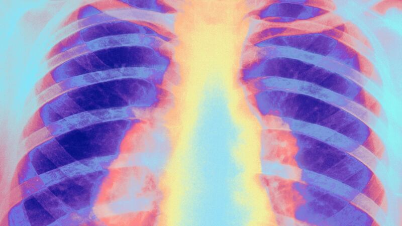 A colour-enhanced X-ray of human chest showing pulmonary tuberculosis. Photograph: Barts Hospital