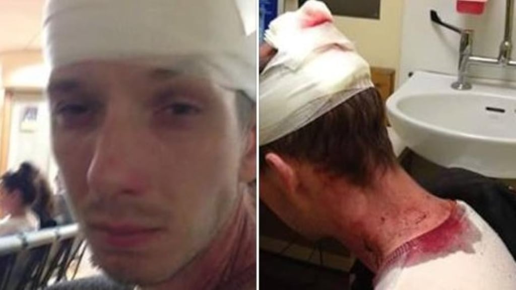 A image posted by Linda Deaton showing injuries to her brother Paul Deaton after he was assaulted by a group of youths in a Dublin park on Wednesday. Image via Facebook