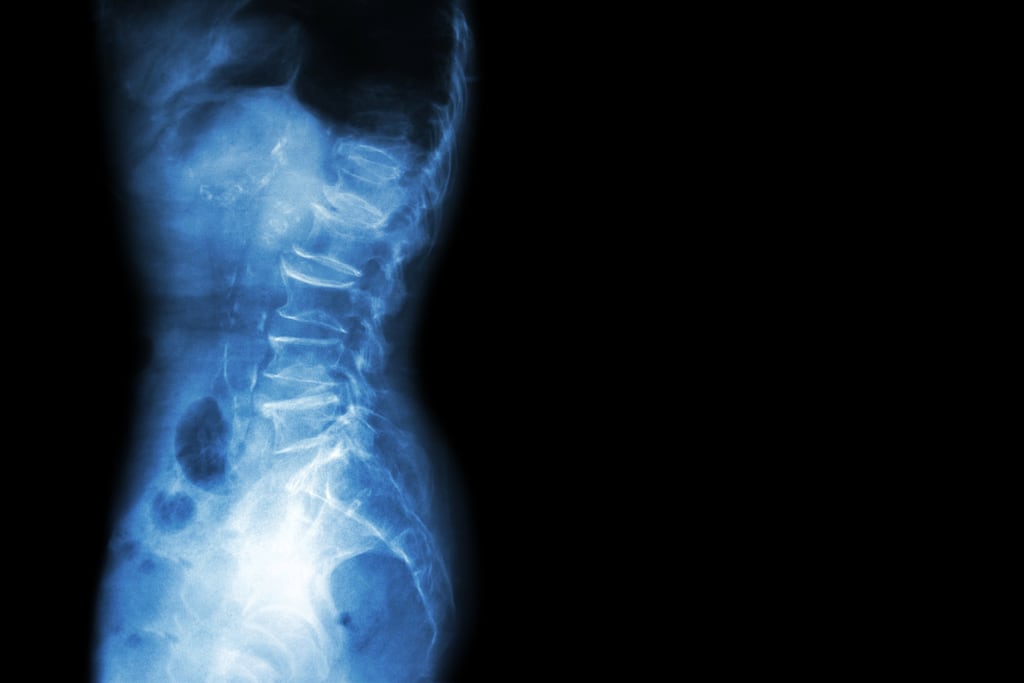 Emma O'Carroll says her diagnosis with axial spondyloarthritis propelled her into a type of grief, where she had to modify her expectations for her life. Photograph: iStock