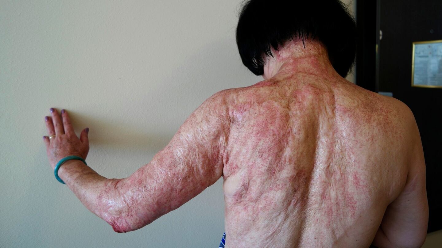 Kim Phuc shows the burn scars on her back and arms after laser treatments in Miami. Photograph: Nick Ut/AP Photo