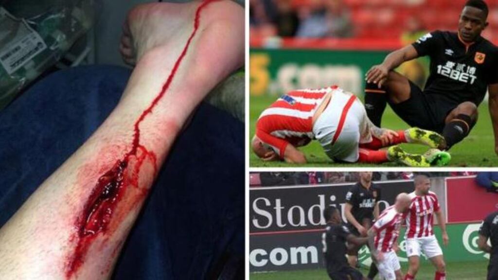 The injury to Ireland that required “something like 12 or 15 stitches”, according to Stoke manager Mark Hughes