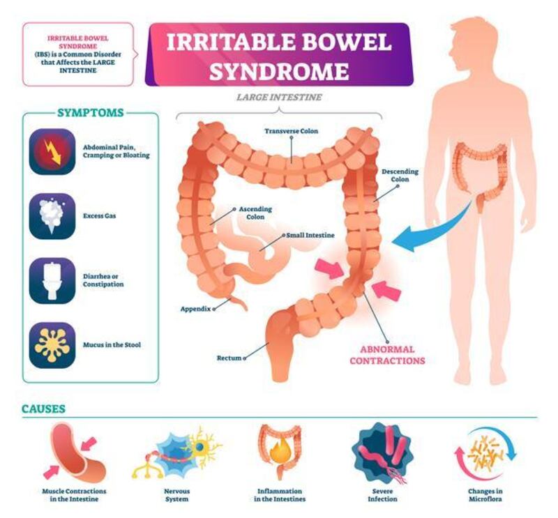 Irritable bowel syndrome illustration.