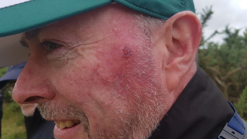 Philip Reid, still all smiles despite the cut on his cheek bone.