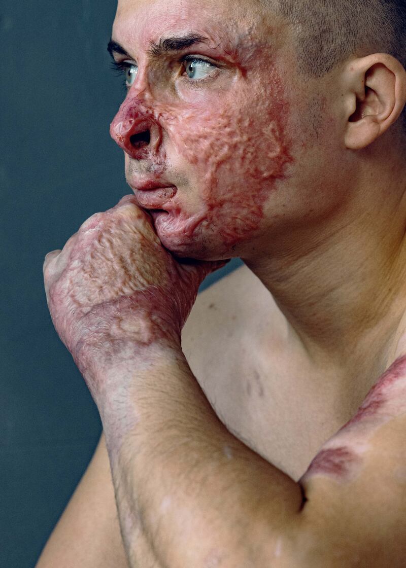 Ukrainian soldier Ilya Pylypenko, who was badly burned in a tank during fighting with Russian forces. The portrait is part of a series by Lviv photographer Marta Syrko. Photograph: Marta Syrko