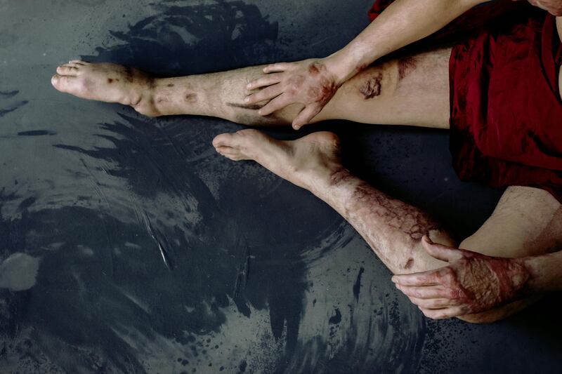 Ukrainian soldier Ilya Pylypenko, who was badly burned in a tank during fighting with Russian forces. Photograph: Marta Syrko