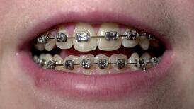 Why are so many adults having braces put on their teeth?