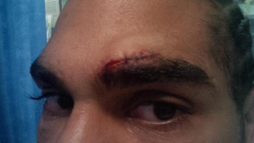 A picture of the cut that has forced David Haye out of hte Tyson Fury fight next week. Photograph: Hayemaker Boxing