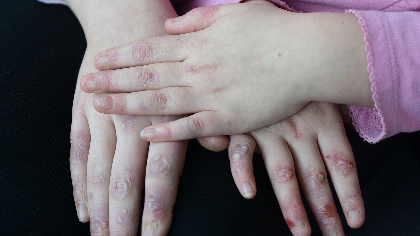 Alison (12) and Erica (6) Hyland, who both have a rare skin condition called epidermolysis bullosa (EB). The condition causes the skin layers and internal body linings to separate, meaning sufferers blister painfully at the slightest touch. Photograph: Dave Meehan/The Irish Times