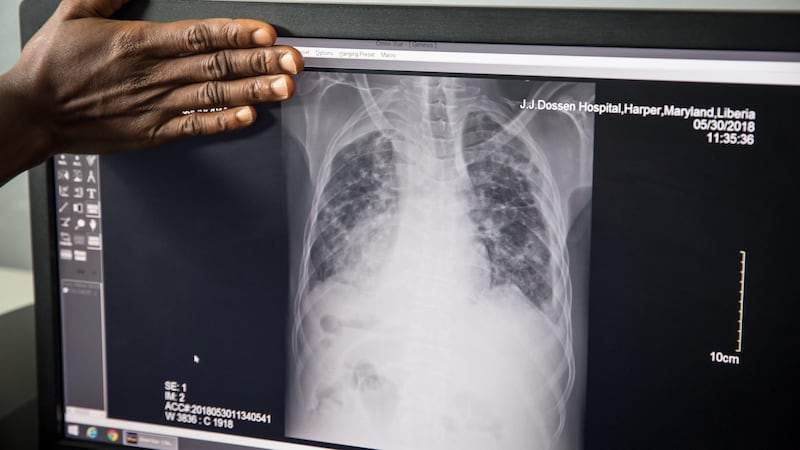 A lung X-ray clearly shows tuberculosis. Photograph: Sally Hayden