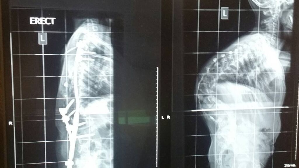 X-rays of the spine of a child with scoliosis after and before surgery.