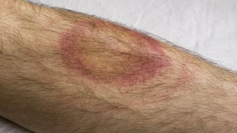 The telltale bullseye rash that indicates Lyme disease. Photograph: iStock