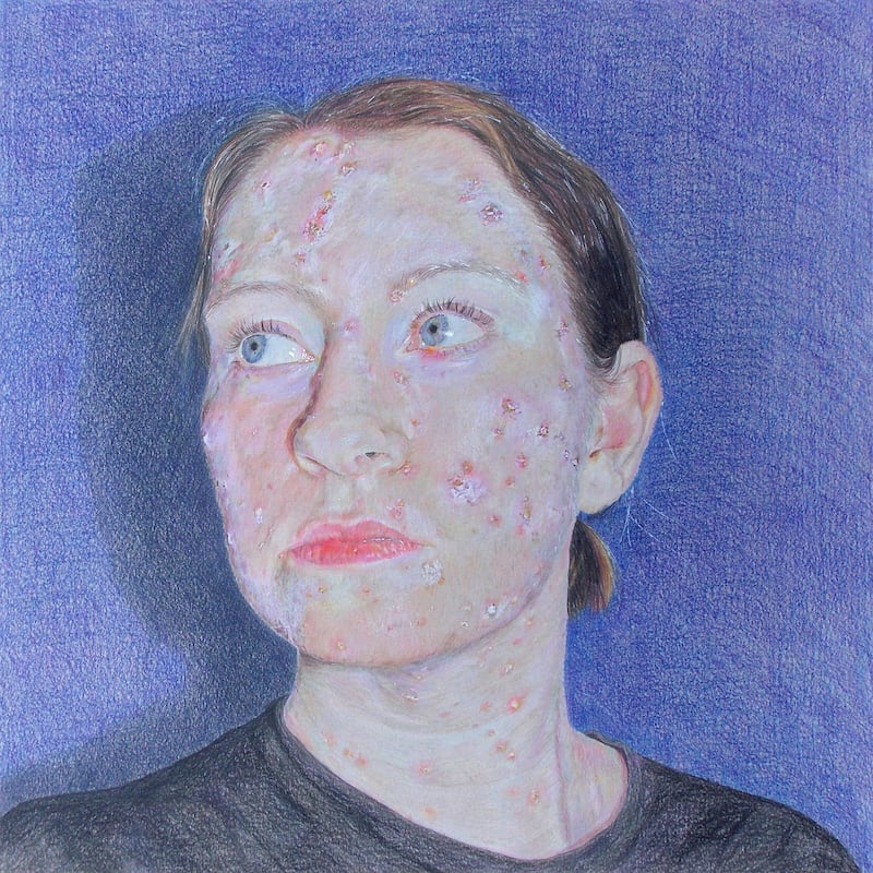 The Pox, by Emily McGardle