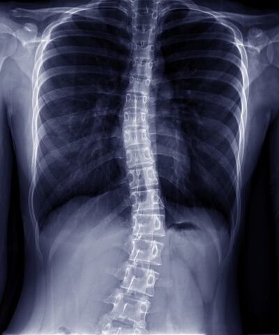 Thoraco-Lumbar scoliosis.