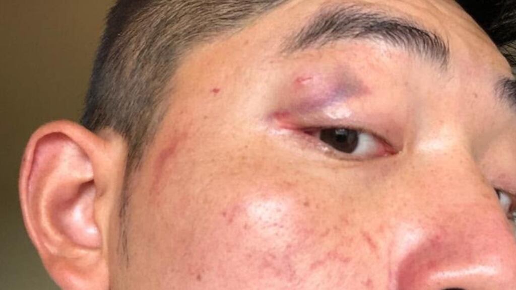 Martin Hong shows a bruise he says he received during a racist attack in Cork earlier this month. Photograph: RTÉ
