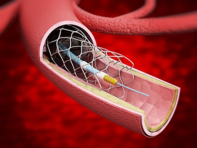 A detailed illustration showing a vascular stent inside the vein