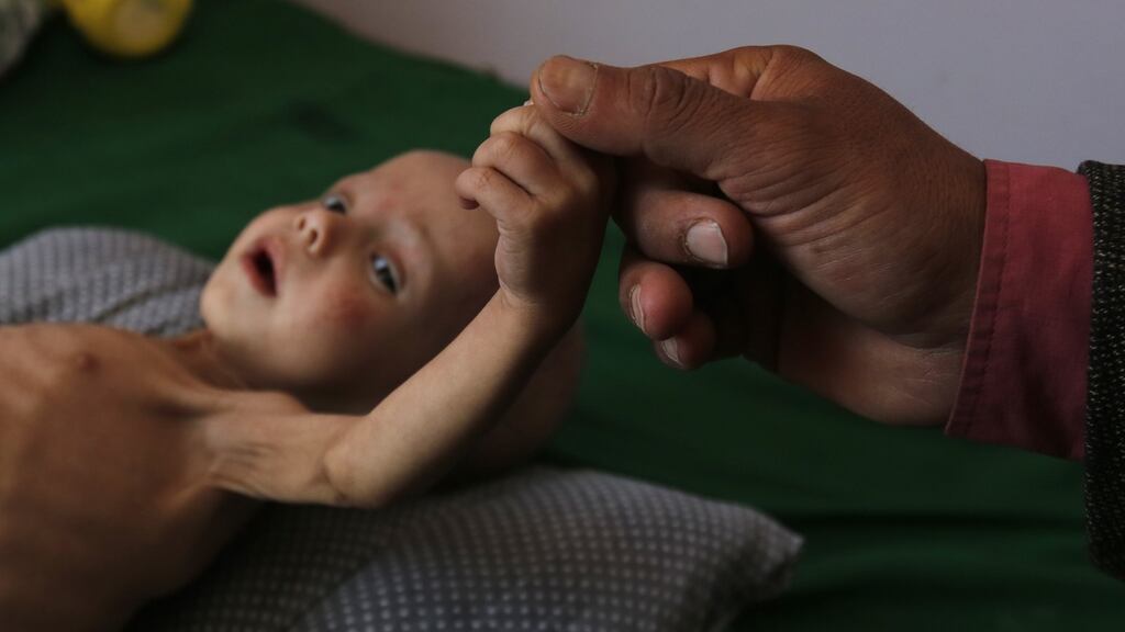 A malnourished Yemeni child receives treatment amid worsening malnutrition in the emergency ward of a hospital in Sana’a, Yemen, on Wednesday. Photograph: Yahya Arhab/EPA