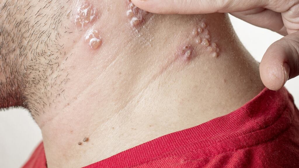 Initially, shingles has the appearance of fluid filled vesicles before becoming a red crusty rash