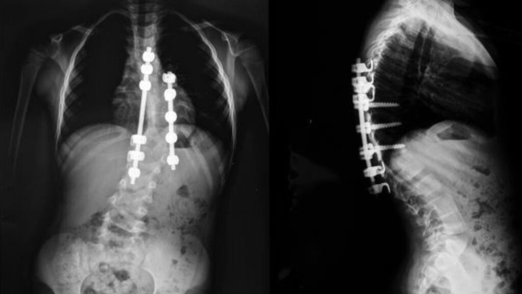 An X-ray taken of a person with scoliosis. File photograph: iStock