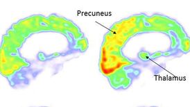 Man in vegetative state for 15 years responds to new therapy