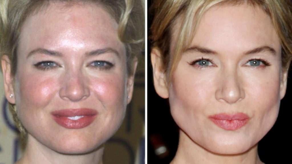 Renée Zellweger: afflicted, like so many of us, with rosacea