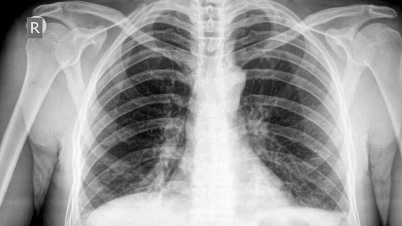 Tuberculosis discovery: The findings, related to a gene known as  MAL,  could lead to personalised treatments for those who develop TB. Photograph: Thinkstock