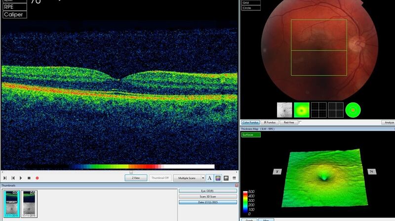 AI software interprets optical coherence tomography scans of the back of the eye.