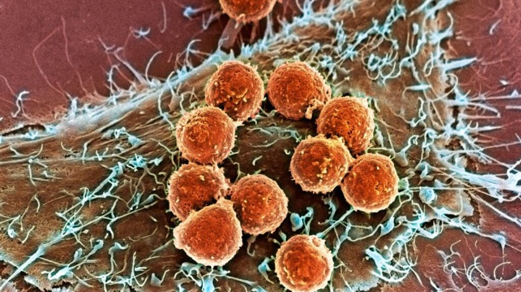 This image, captured by a scanning electron microscope, shows T cells (orange) attached to a tumour cell. Innovative treatments harness the ability of T cells to recognize and destroy cancer cells.