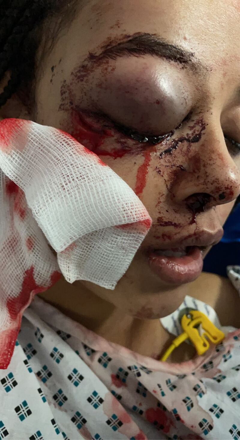 Alanna Quinn Idris (17) was left with severe facial injuries - including a ruptured eyeball