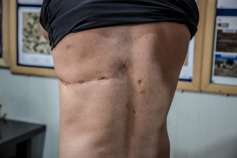 Faisal Barkal (44) got involved in demining after he was injured by an explosive while trying to return to his home. Photograph: Sally Hayden