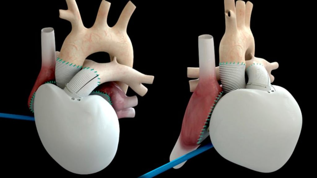 Both sides of the mechanical heart created by Carmat. The self-contained unit is powered by a lithium battery and weighs 900 grams. Photograph: Carmat handout/EPA
