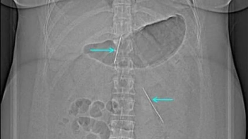 Another part of the X-ray, showing sewing needles lodged in the woman’s abdomen.