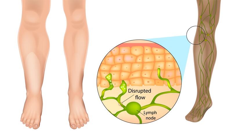 Lymphoedema is a long-term condition that causes swelling in the body's tissues.