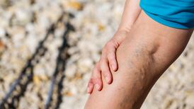 10 things you didn’t know about varicose veins